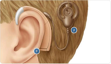 Cochlear2.gif