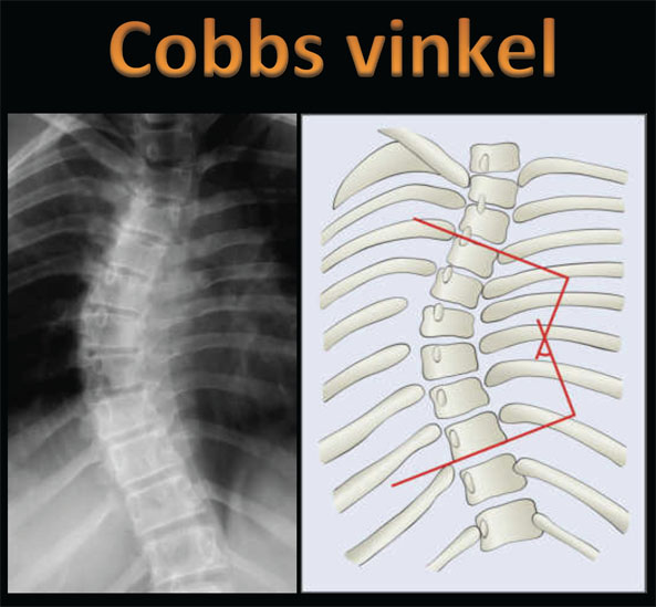 Udmåling af skoliosevinkel - Cobbs vinkel