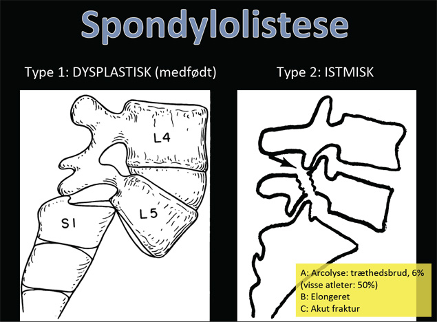Spondylolistese mellem L5 og S1