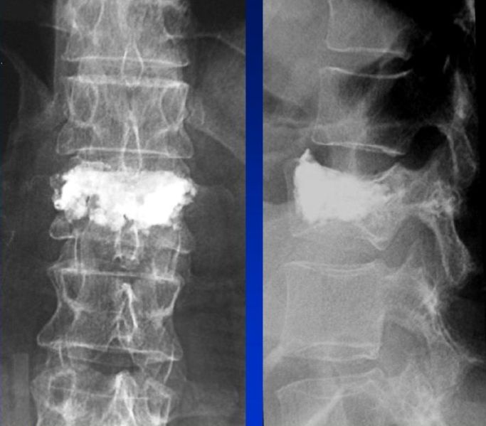 Fil:Vertebroplastik2.jpg