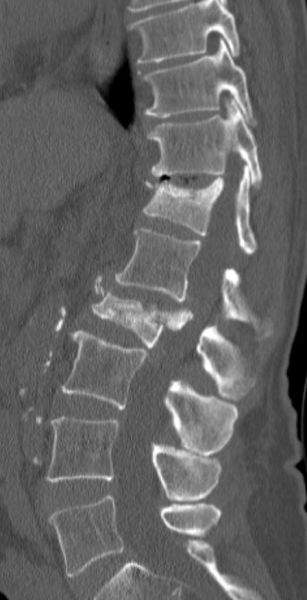 Fil:Osteoporose fraktur L2.jpg